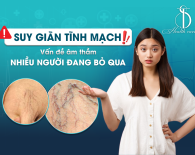 Suy giãn tĩnh mạch – Vấn đề âm thầm nhiều người đang bỏ qua