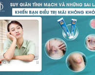 Suy giãn tĩnh mạch và những sai lầm khiến bạn điều trị mãi không khỏi