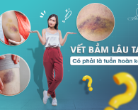Vết bầm lâu tan: Có phải là tuần hoàn kém