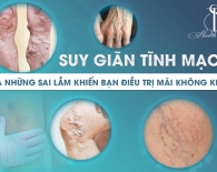 Suy giãn tĩnh mạch và những sai lầm khiến bạn điều trị mãi không khỏi - Bạn nên biết