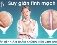 Suy giãn tĩnh mạch – Căn bệnh âm thầm không nên chủ quan